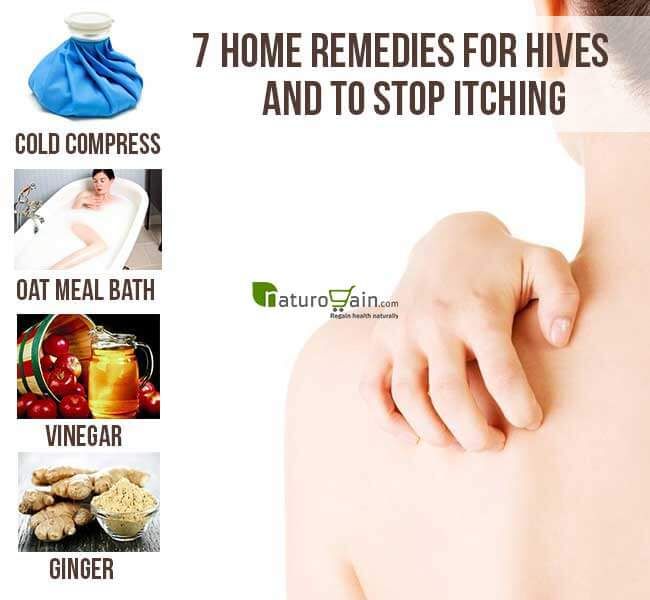 7 Home Remedies for Hives to Stop Itching at Home