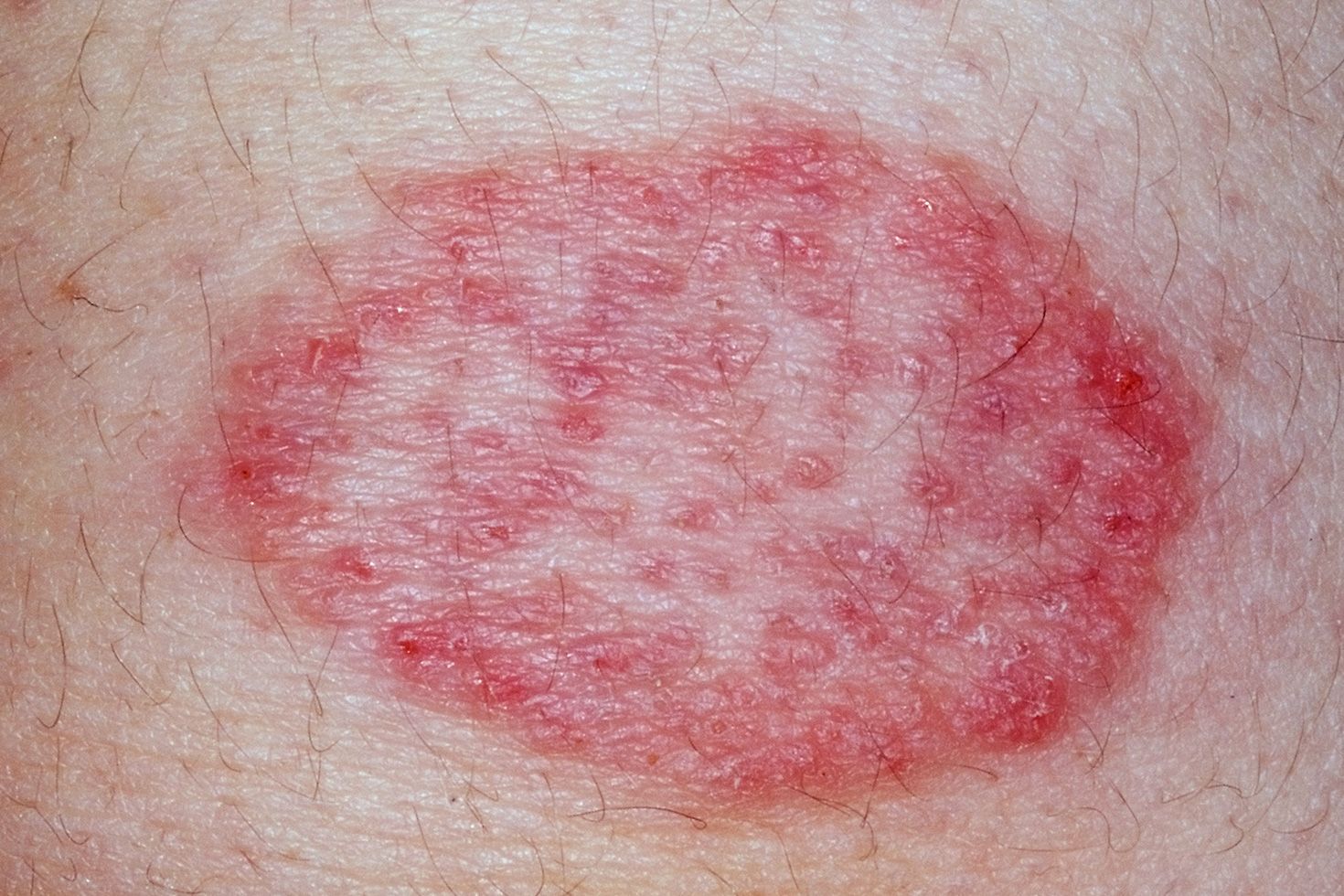 poison-ivy-rash-go-away-on-its-own