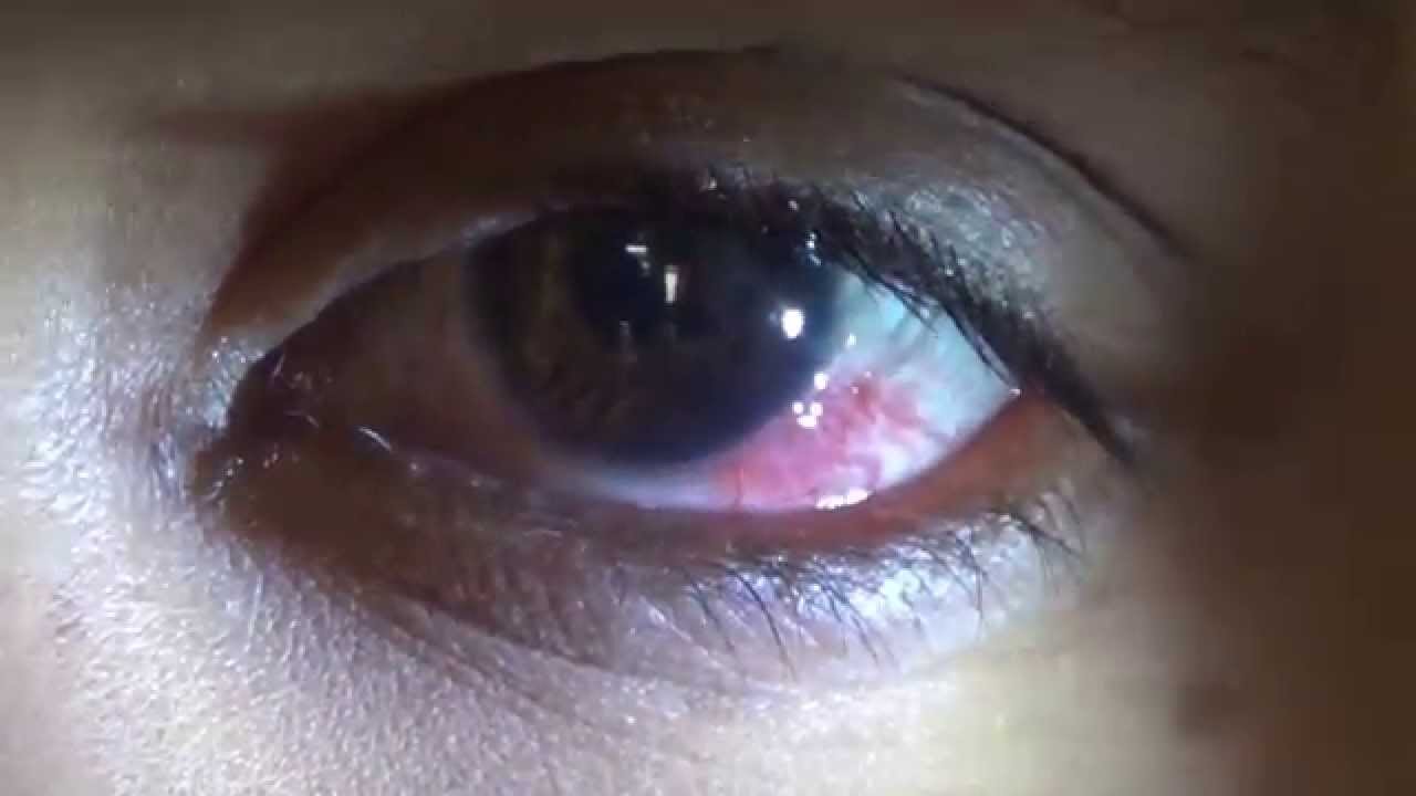 HIV AFFECTED : EYE DETAILS