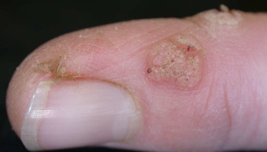 hiv transmission through finger cuts