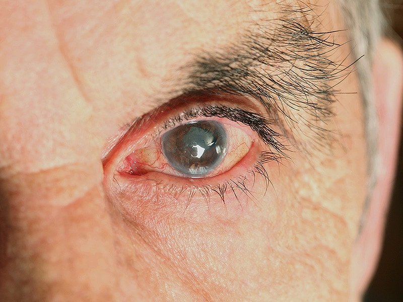 Vitamin E, Selenium: No Effect on Cataract Risk in Men